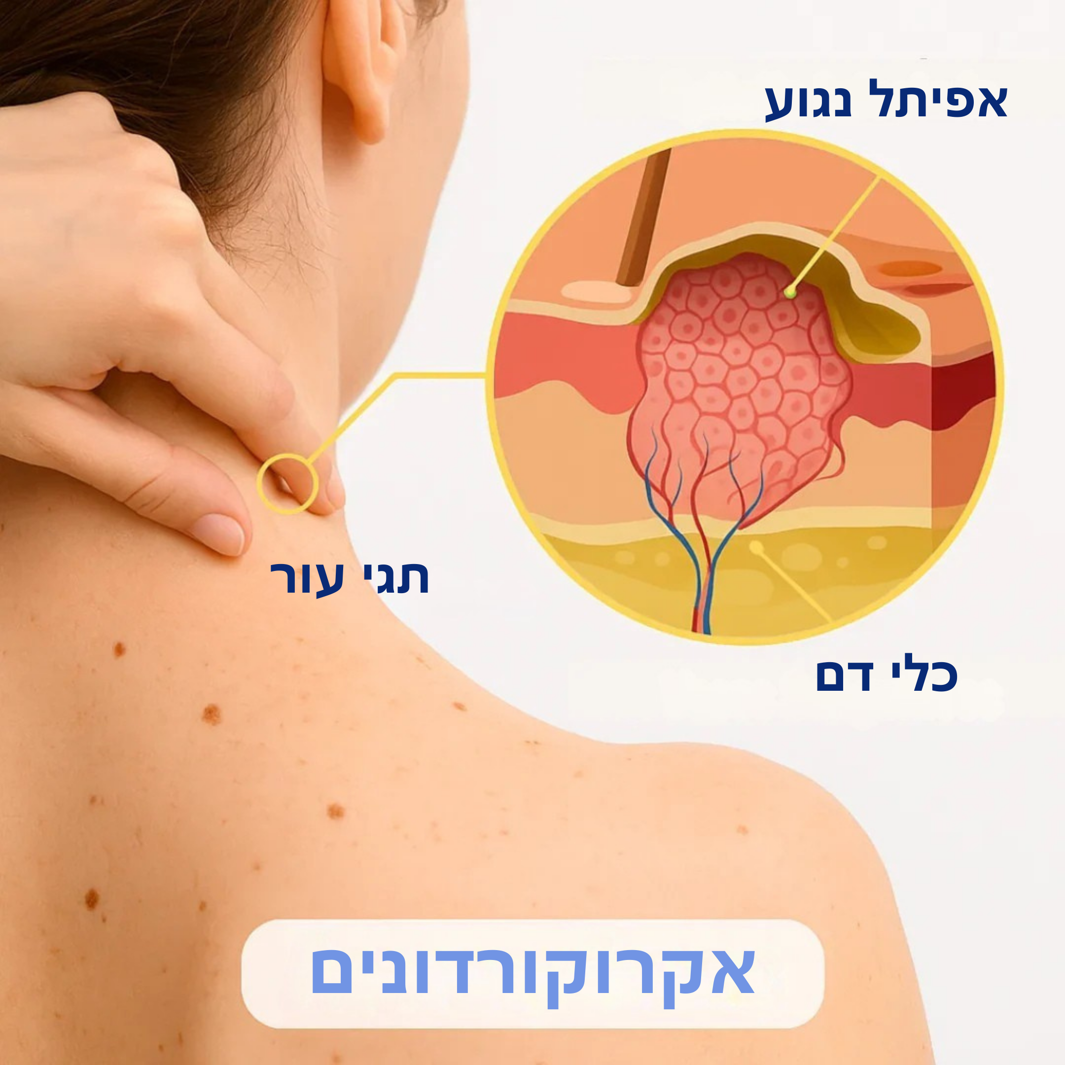 ביאוקליר™ – פתרון ביולוגי בארס דבורים להסרת תגי עור ויבלות