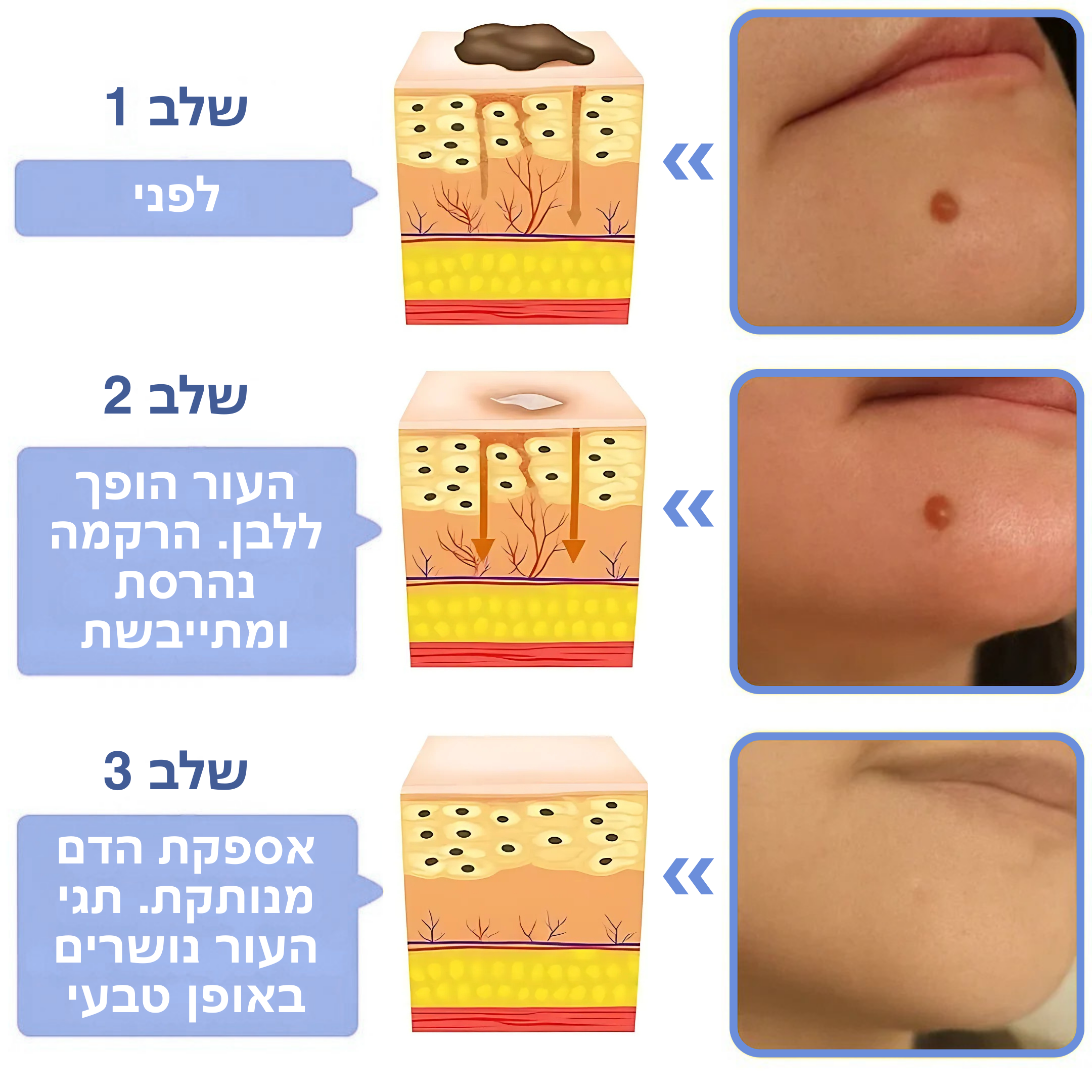 ביאוקליר™ – פתרון ביולוגי בארס דבורים להסרת תגי עור ויבלות