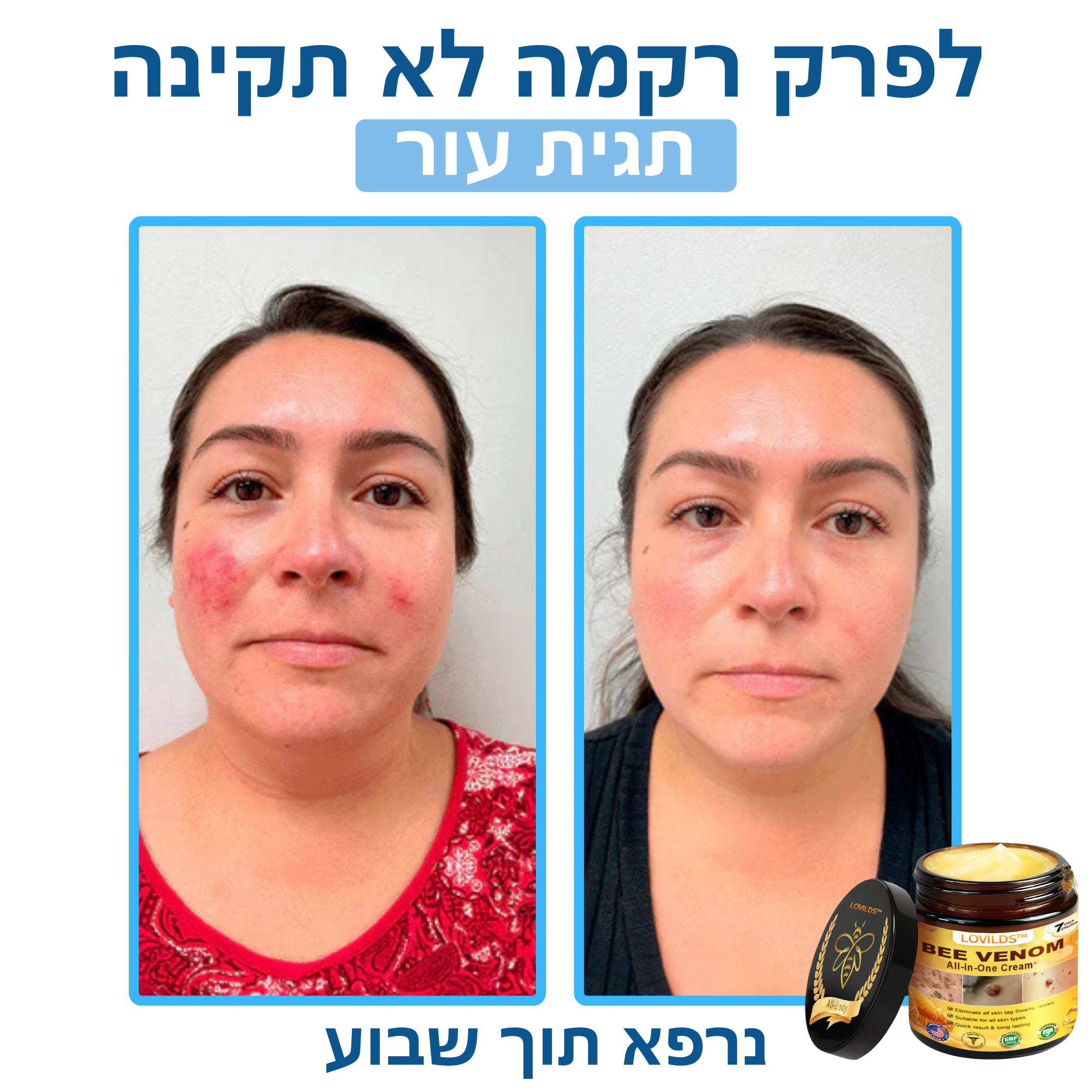 LOVILDS™ – קרם ארס דבורים לטיפול טבעי בבעיות עור
