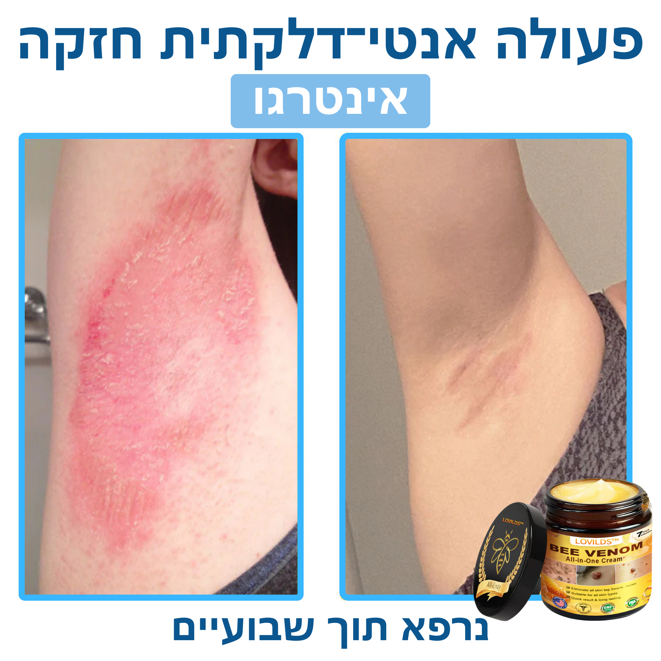 LOVILDS™ – קרם ארס דבורים לטיפול טבעי בבעיות עור