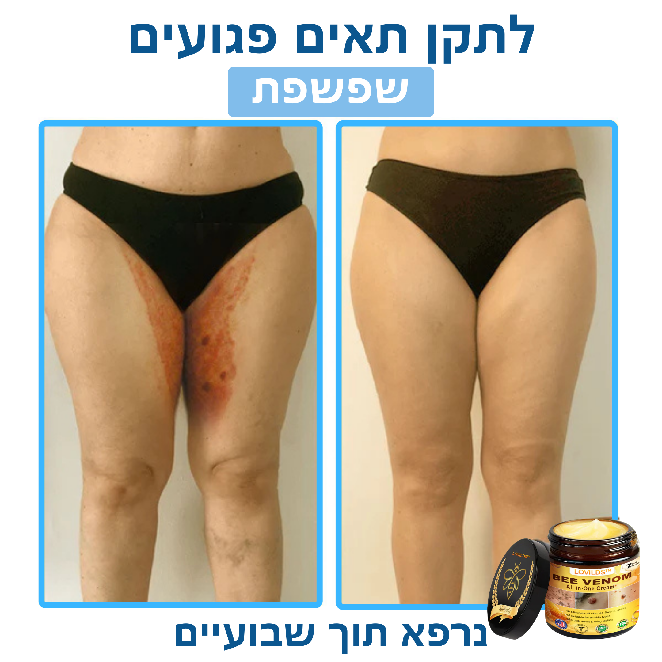 LOVILDS™ – קרם ארס דבורים לטיפול טבעי בבעיות עור