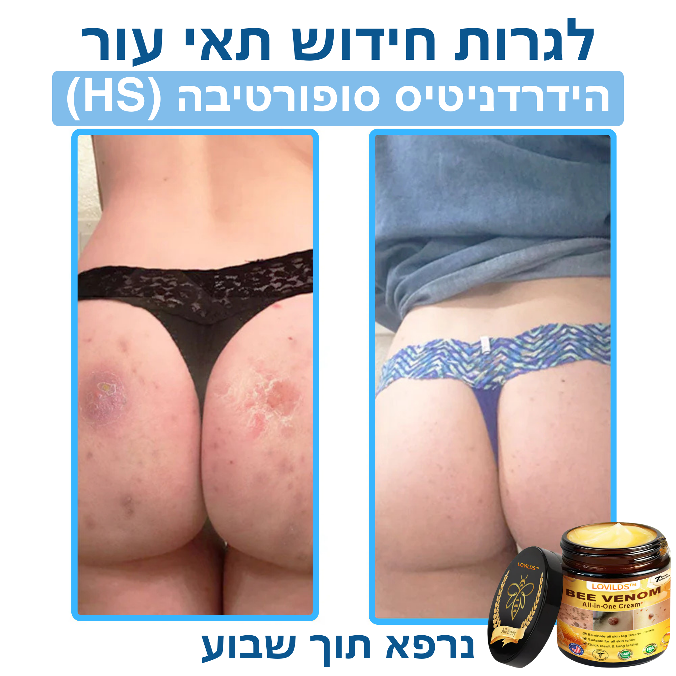 LOVILDS™ – קרם ארס דבורים לטיפול טבעי בבעיות עור