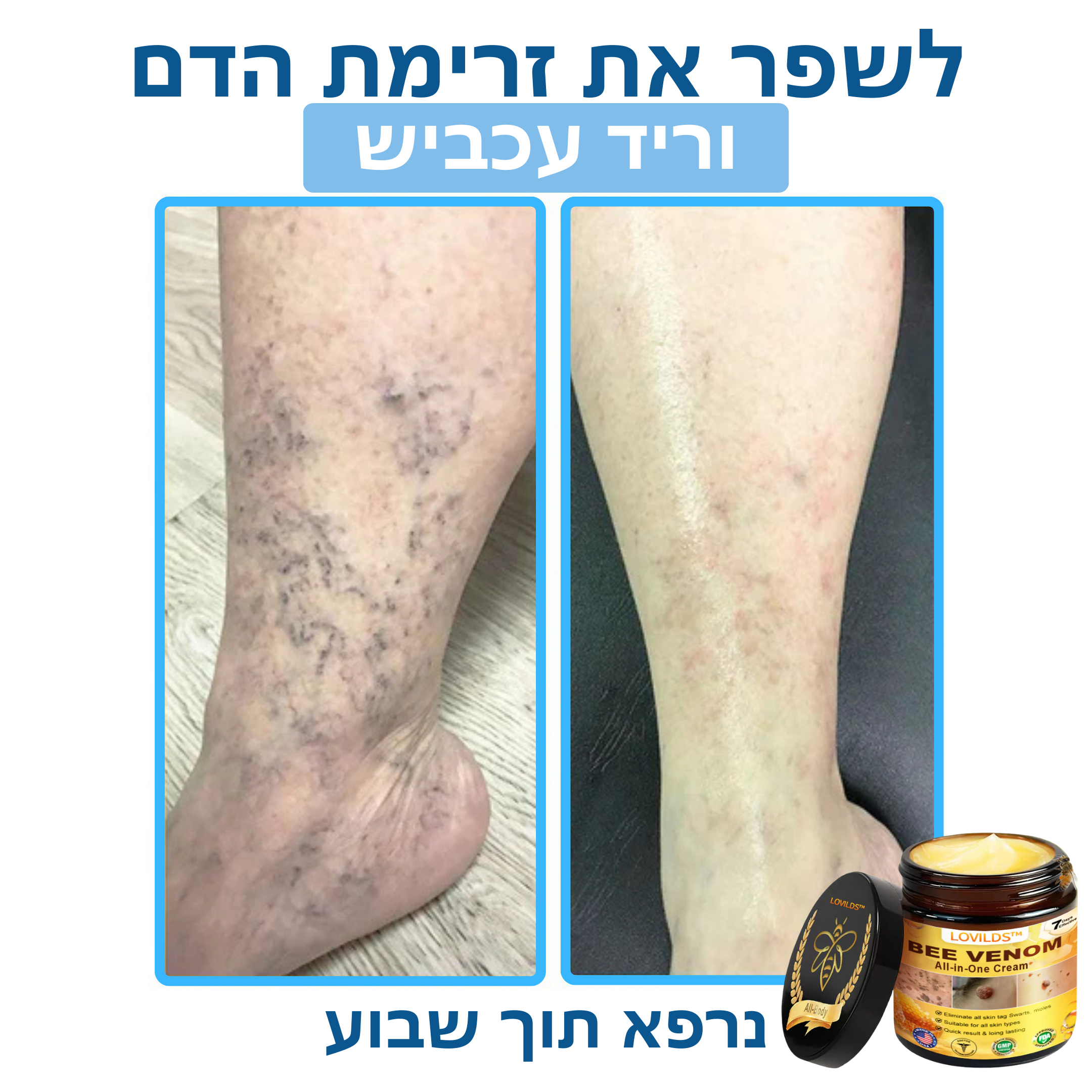 LOVILDS™ – קרם ארס דבורים לטיפול טבעי בבעיות עור