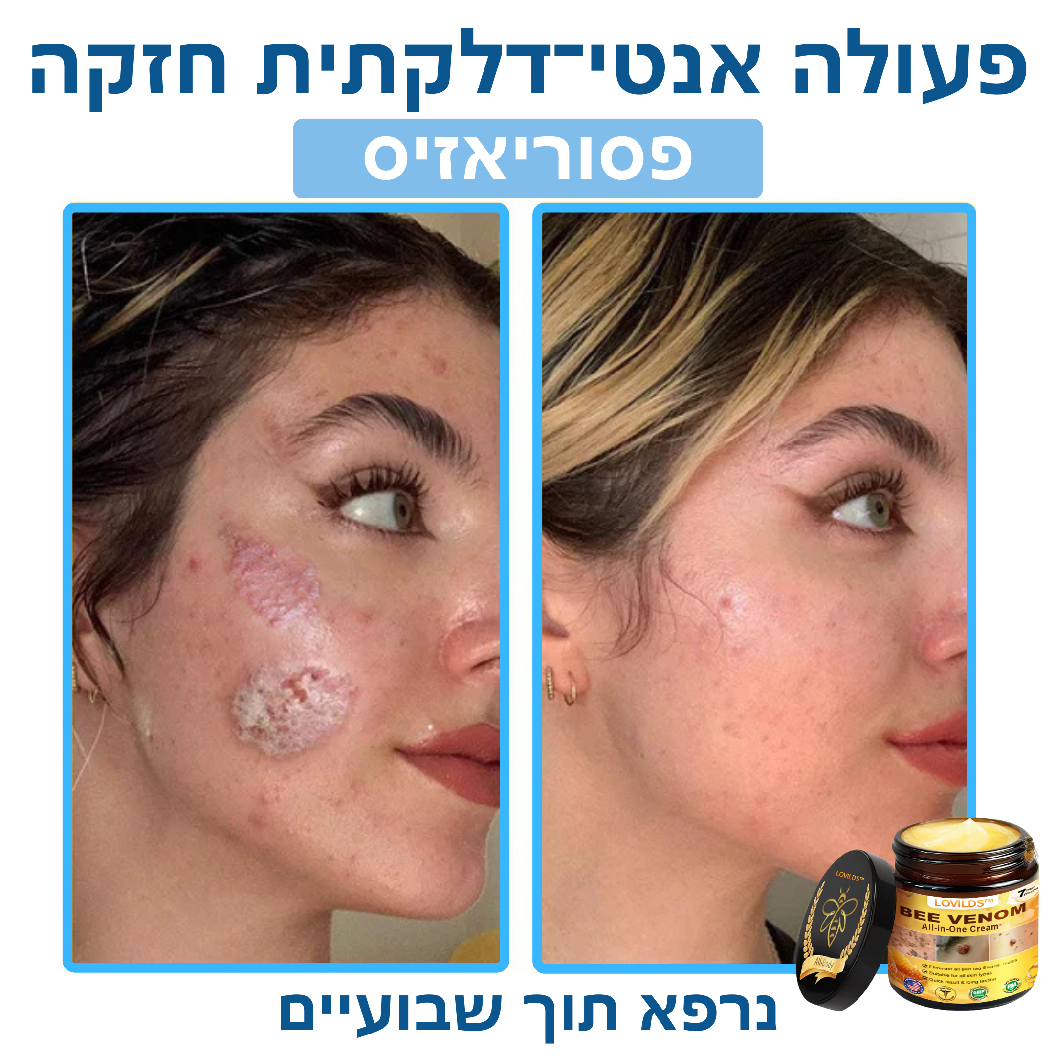 LOVILDS™ – קרם ארס דבורים לטיפול טבעי בבעיות עור