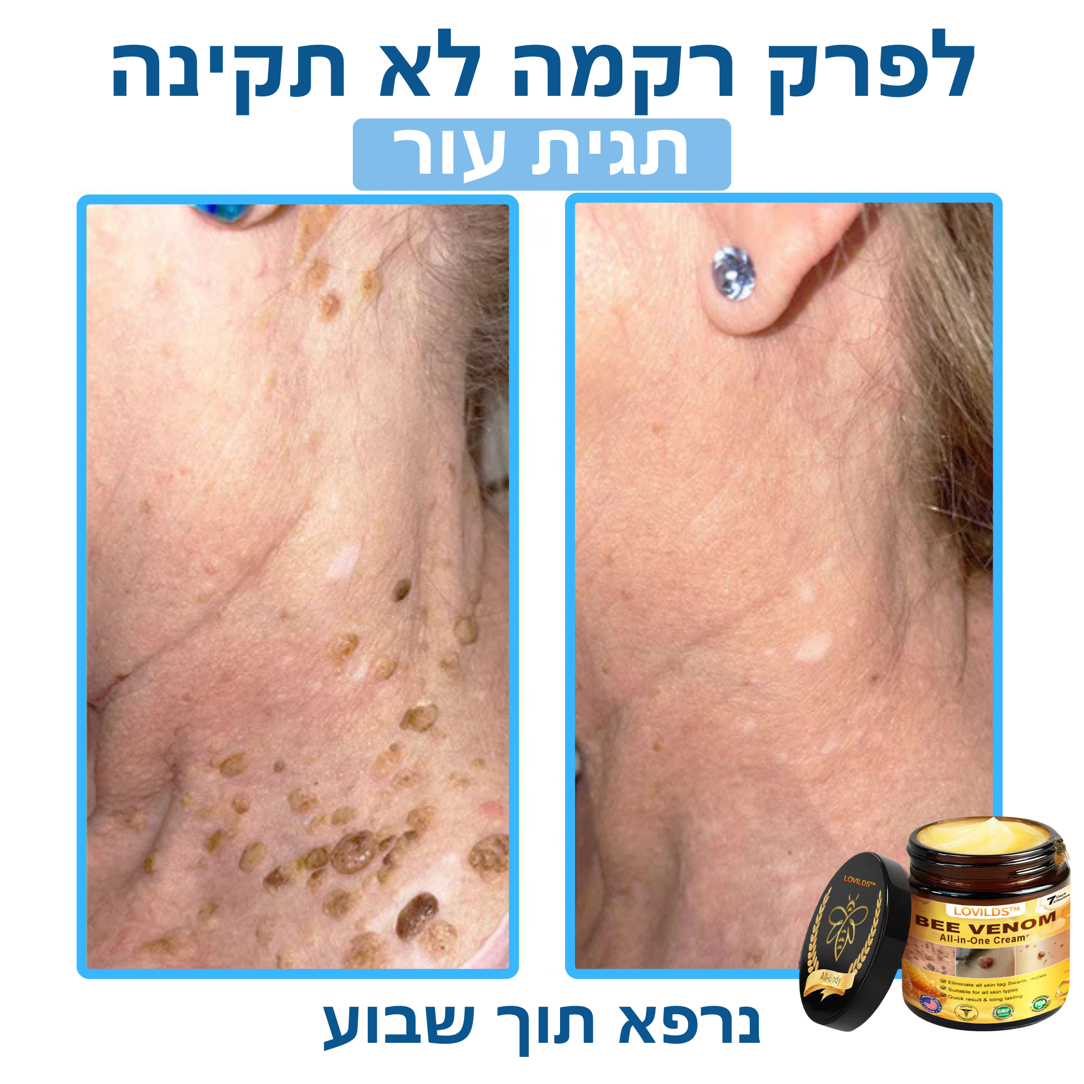 LOVILDS™ – קרם ארס דבורים לטיפול טבעי בבעיות עור